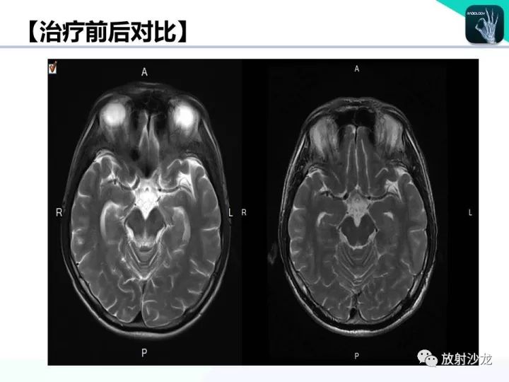 【病例】Wernicke脑病1例MR