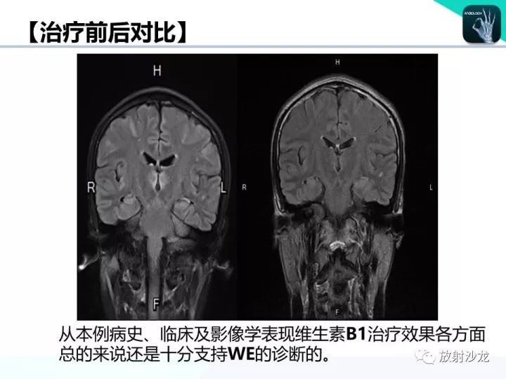 【病例】Wernicke脑病1例MR