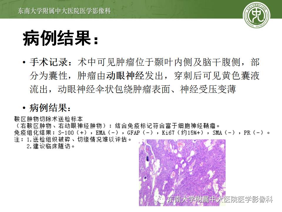 【病例】鞍旁动眼神经鞘瘤1例MR