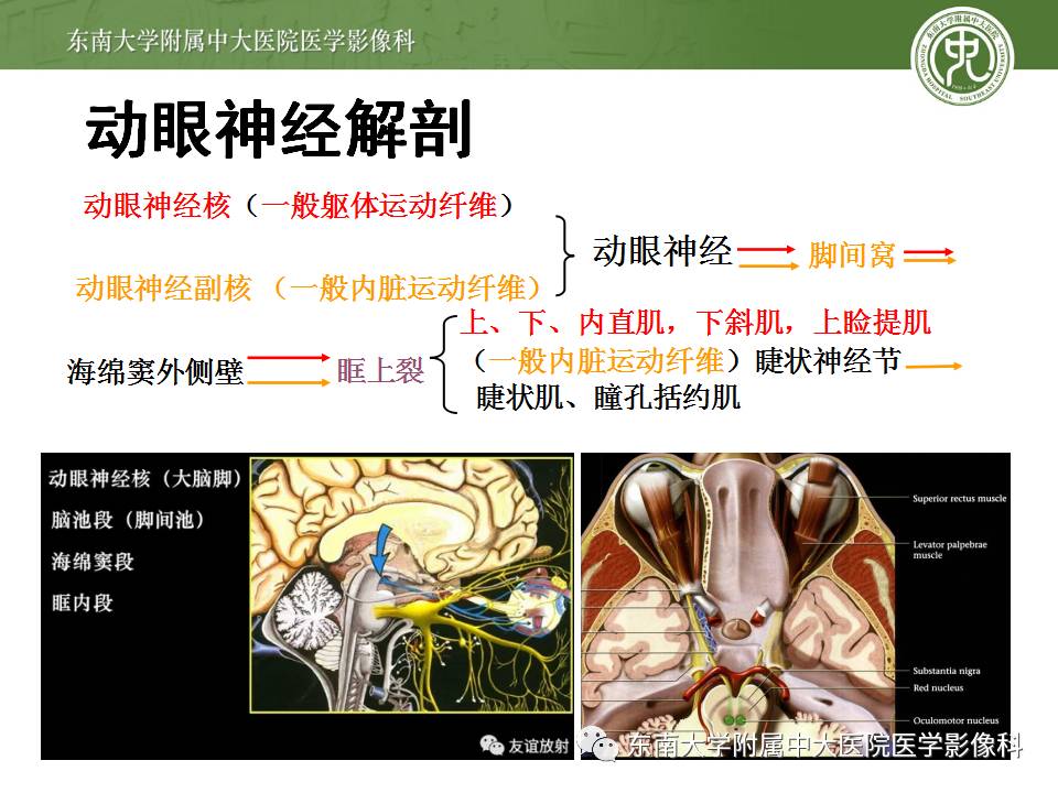 【病例】鞍旁动眼神经鞘瘤1例MR