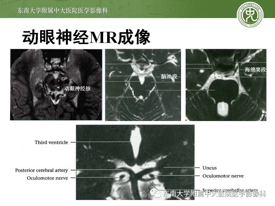 【病例】鞍旁动眼神经鞘瘤1例MR