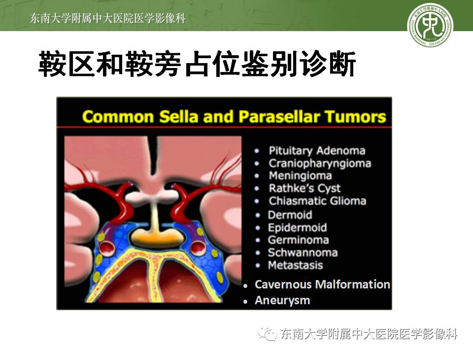 【病例】鞍旁动眼神经鞘瘤1例MR