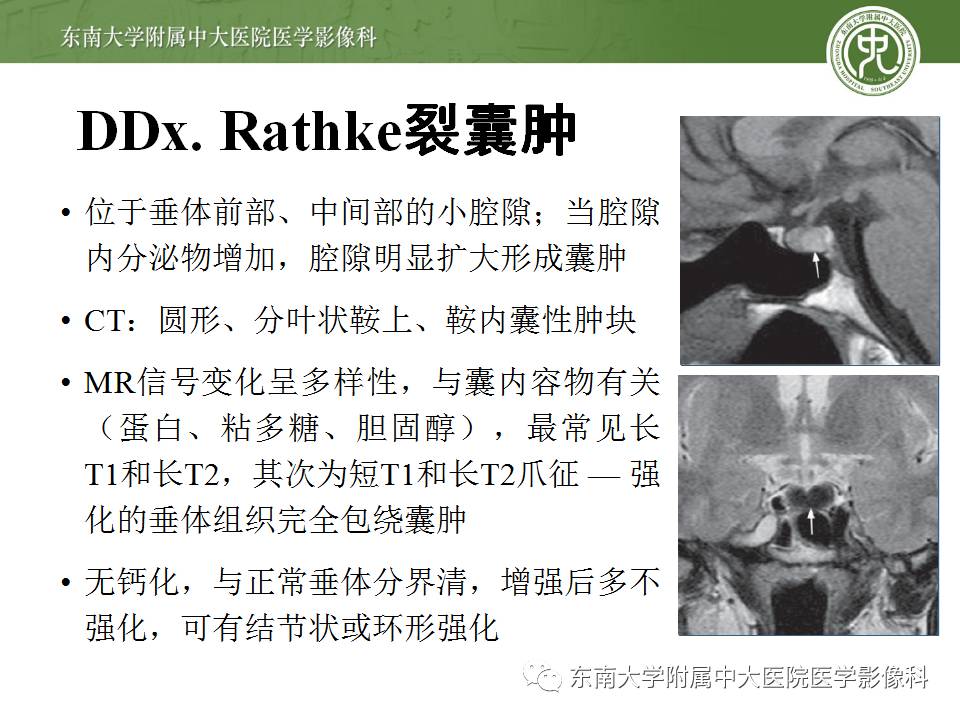 【病例】鞍旁动眼神经鞘瘤1例MR