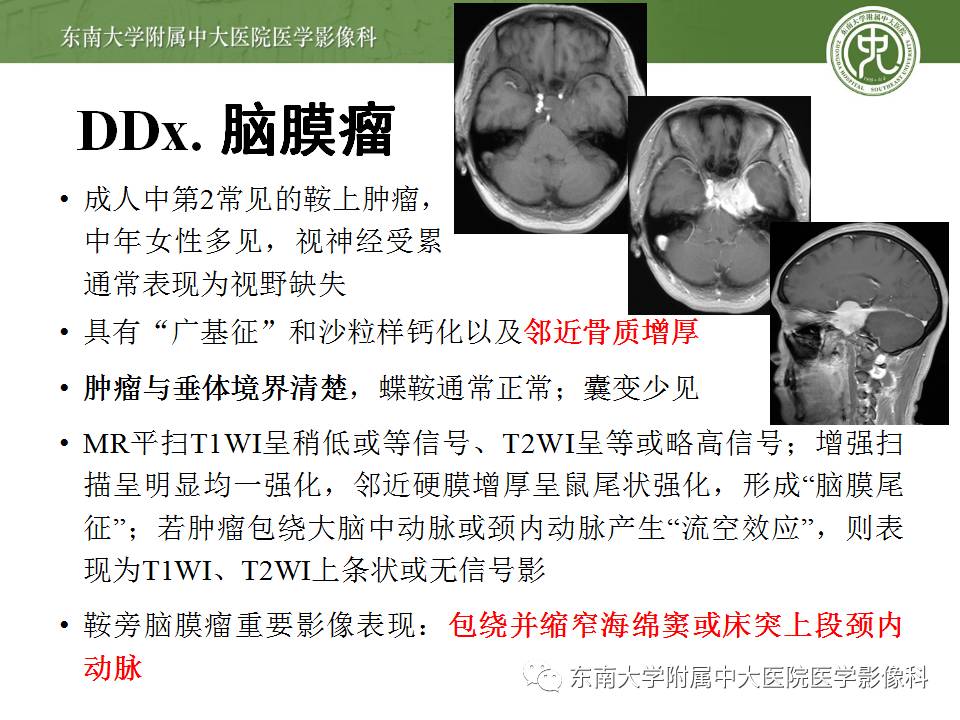 【病例】鞍旁动眼神经鞘瘤1例MR