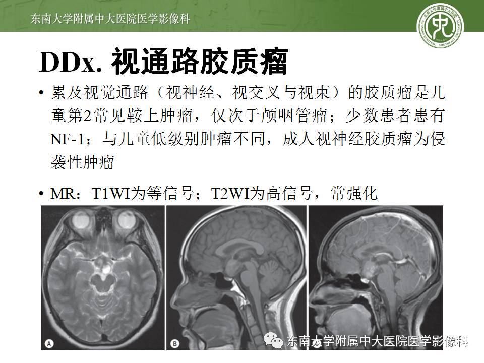 【病例】鞍旁动眼神经鞘瘤1例MR