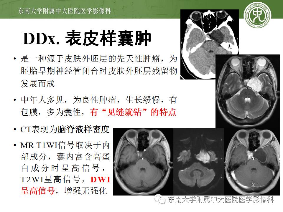 【病例】鞍旁动眼神经鞘瘤1例MR