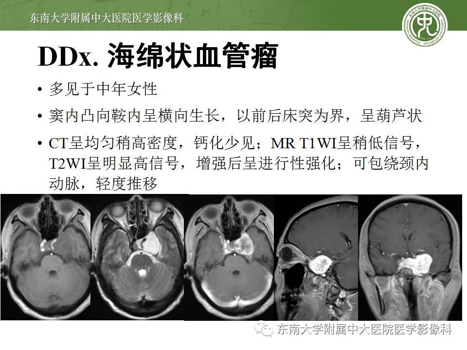 【病例】鞍旁动眼神经鞘瘤1例MR