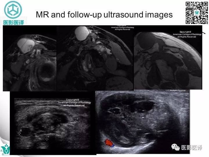 【病例】肩锁关节囊肿—喷泉征1例MR