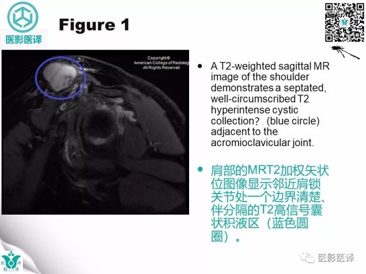 【病例】肩锁关节囊肿—喷泉征1例MR
