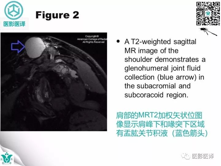 【病例】肩锁关节囊肿—喷泉征1例MR