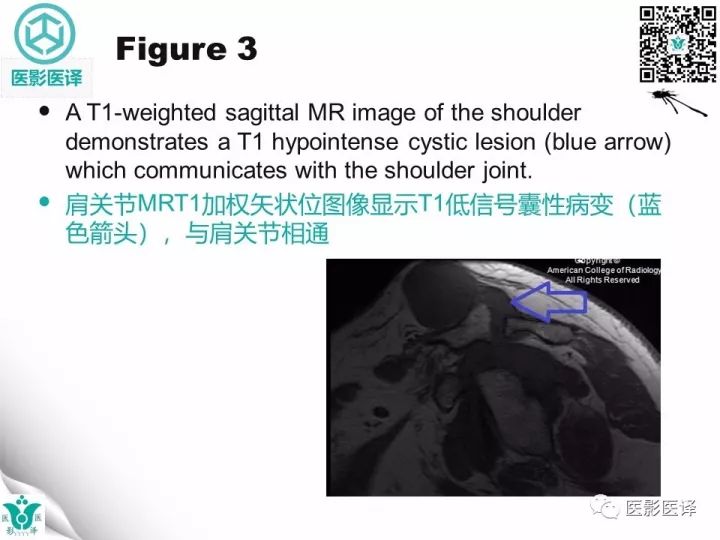 【病例】肩锁关节囊肿—喷泉征1例MR