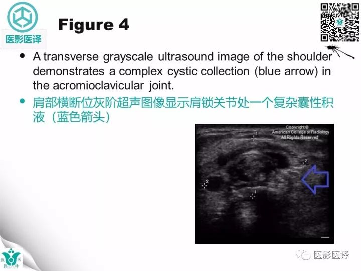 【病例】肩锁关节囊肿—喷泉征1例MR