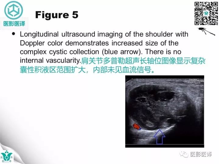 【病例】肩锁关节囊肿—喷泉征1例MR