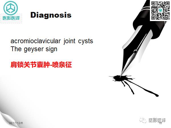 【病例】肩锁关节囊肿—喷泉征1例MR