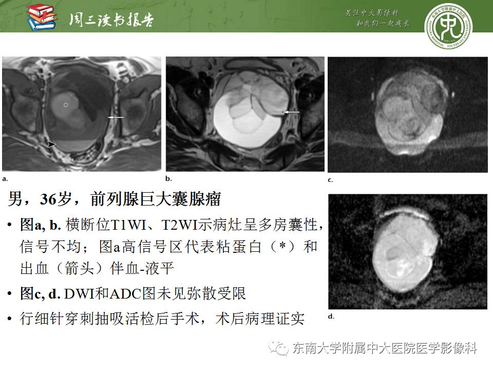 【PPT】超越前列腺腺癌：扩大前列腺病变MR鉴别诊断