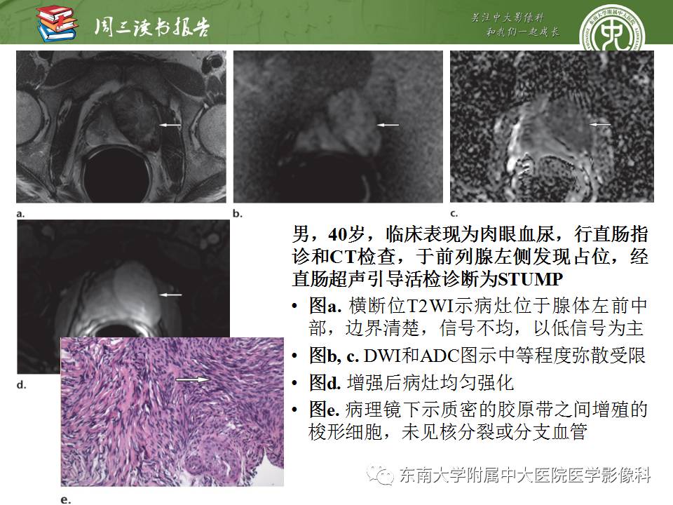【PPT】超越前列腺腺癌：扩大前列腺病变MR鉴别诊断