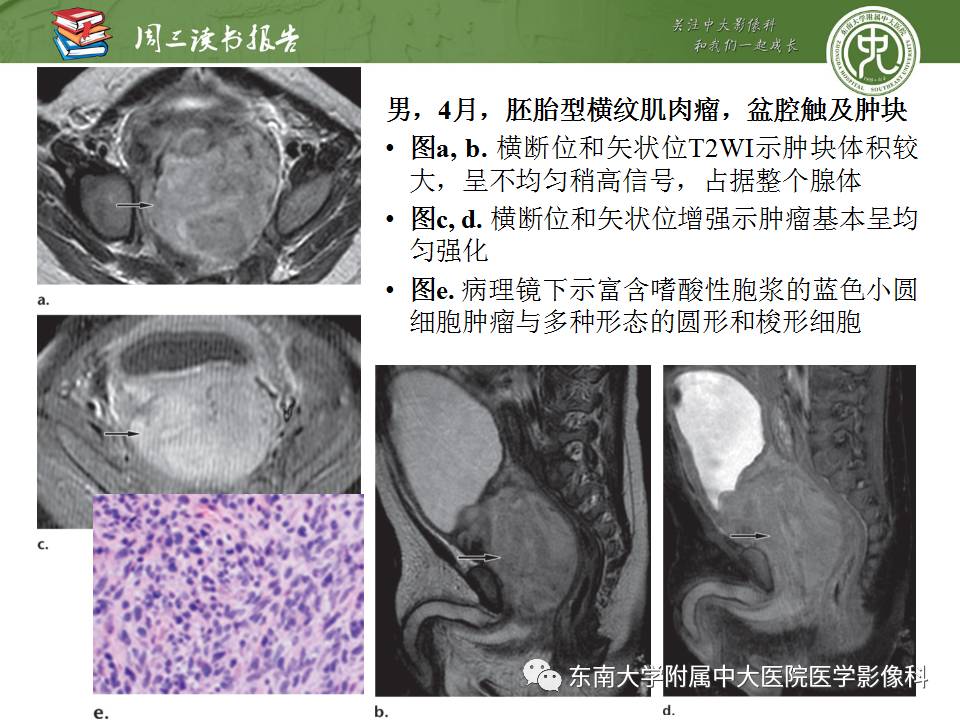 【PPT】超越前列腺腺癌：扩大前列腺病变MR鉴别诊断