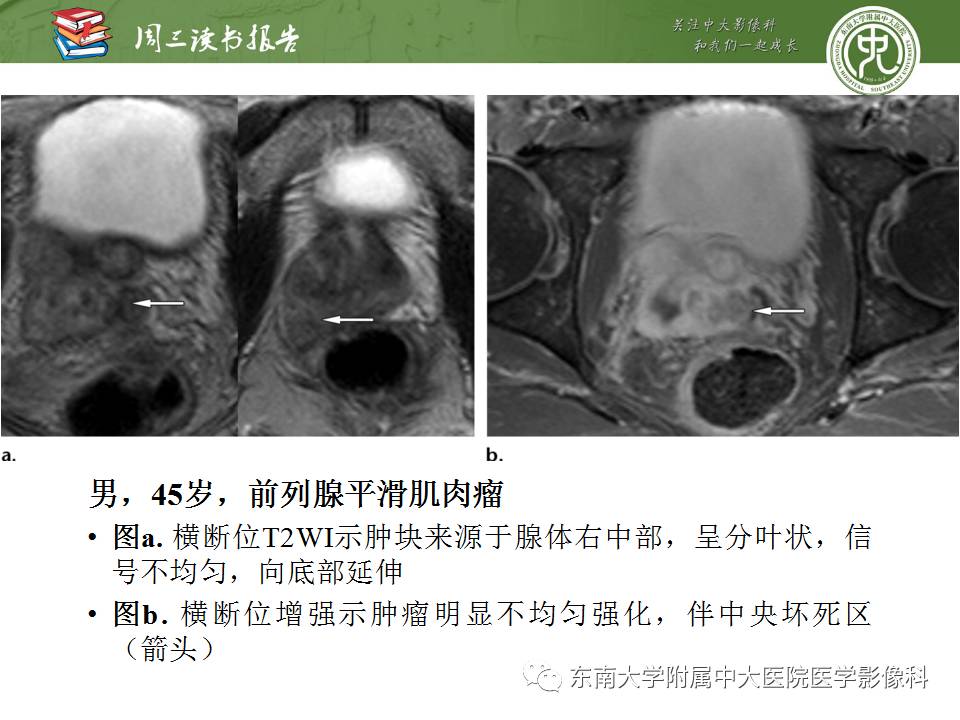 【PPT】超越前列腺腺癌：扩大前列腺病变MR鉴别诊断