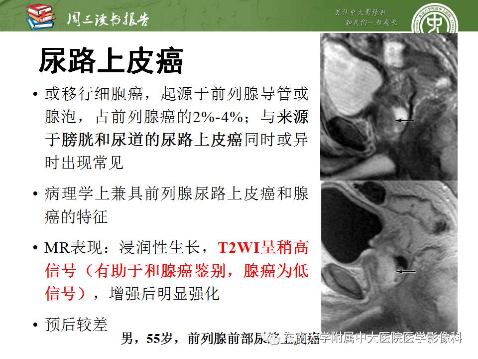 【PPT】超越前列腺腺癌：扩大前列腺病变MR鉴别诊断