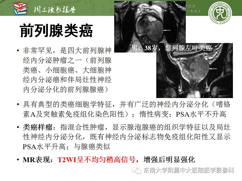 【PPT】超越前列腺腺癌：扩大前列腺病变MR鉴别诊断