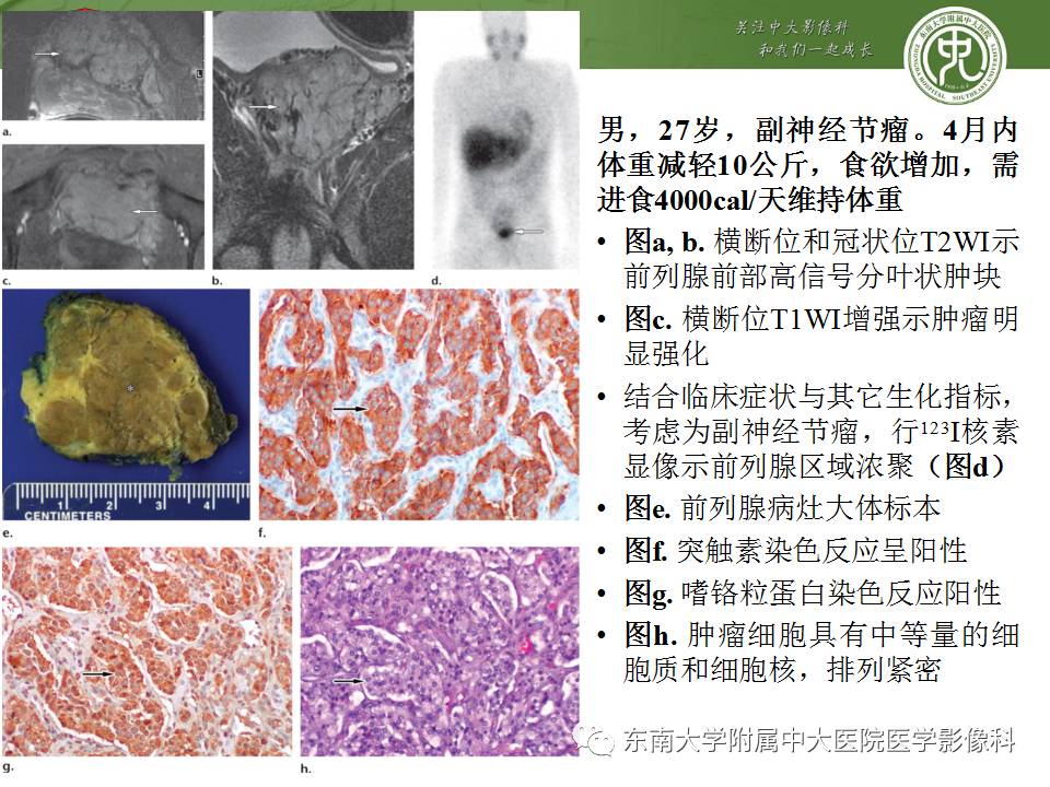 【PPT】超越前列腺腺癌：扩大前列腺病变MR鉴别诊断