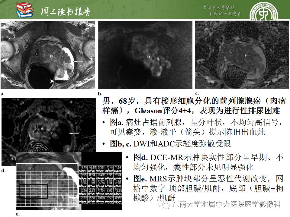 【PPT】超越前列腺腺癌：扩大前列腺病变MR鉴别诊断