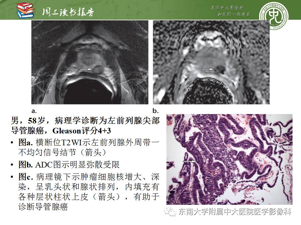 【PPT】超越前列腺腺癌：扩大前列腺病变MR鉴别诊断