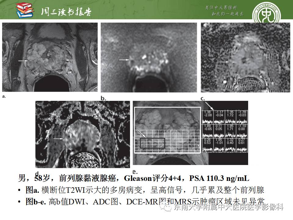 【PPT】超越前列腺腺癌：扩大前列腺病变MR鉴别诊断