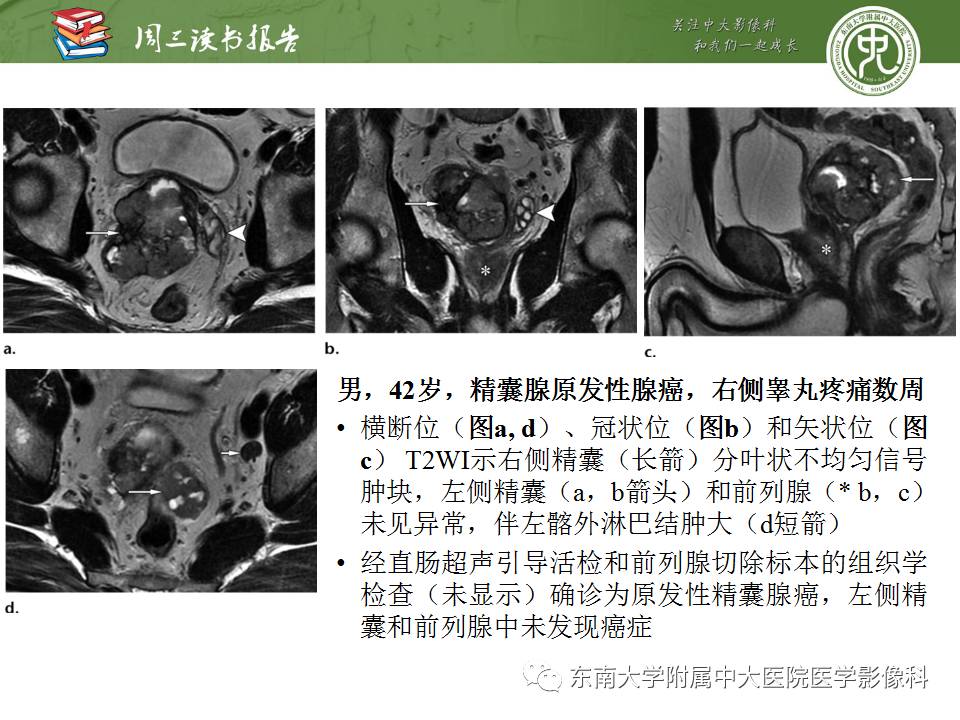 【PPT】超越前列腺腺癌：扩大前列腺病变MR鉴别诊断
