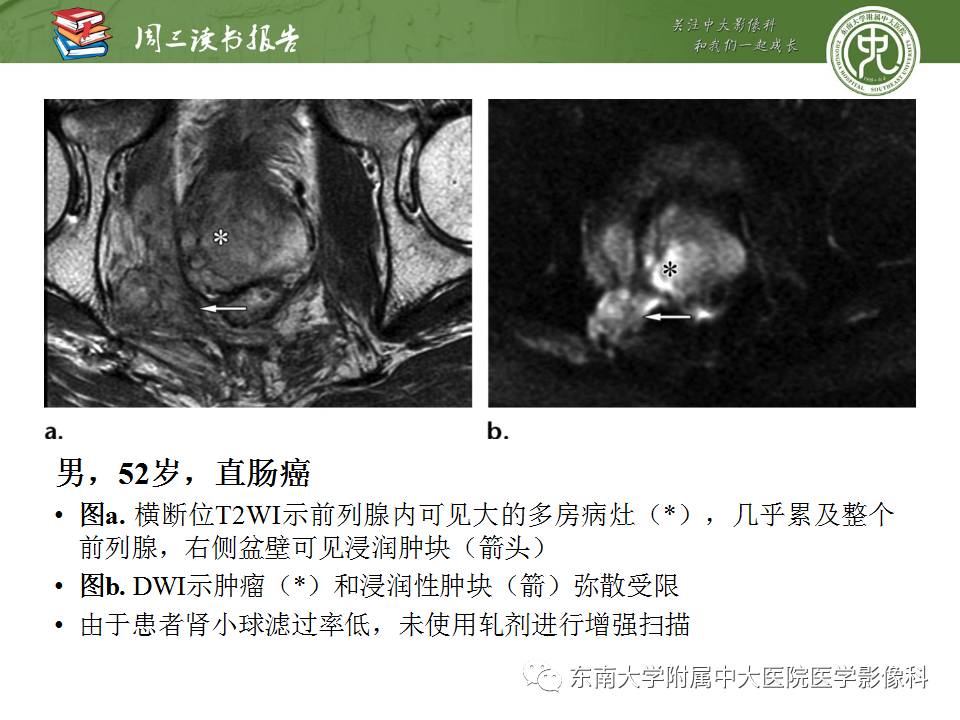 【PPT】超越前列腺腺癌：扩大前列腺病变MR鉴别诊断