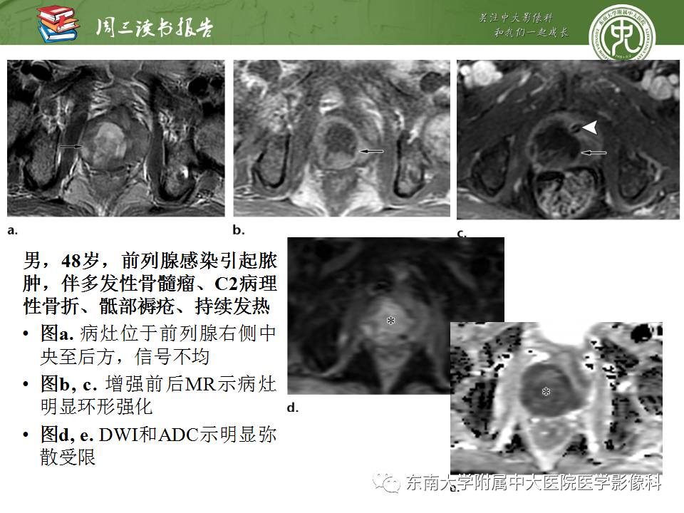 【PPT】超越前列腺腺癌：扩大前列腺病变MR鉴别诊断