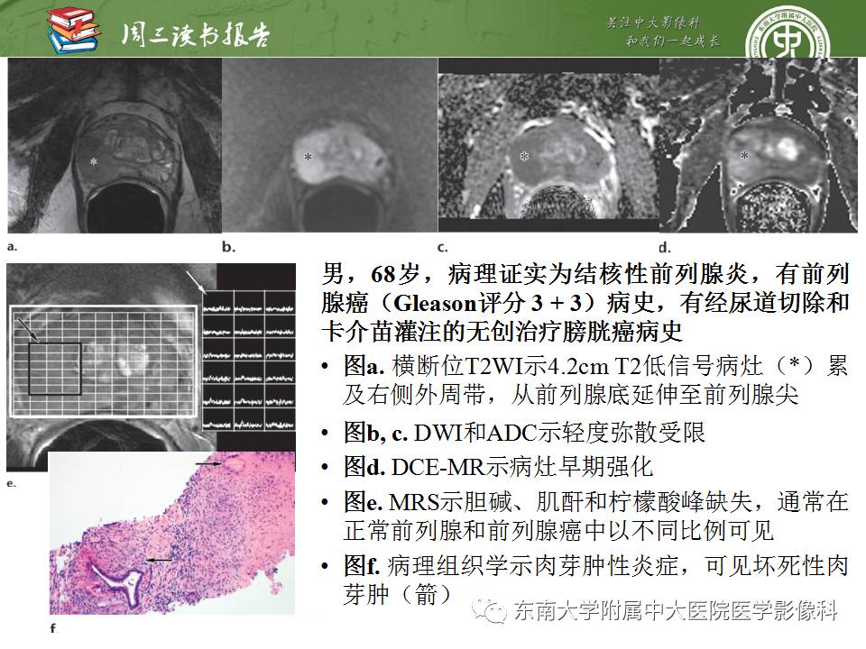 【PPT】超越前列腺腺癌：扩大前列腺病变MR鉴别诊断