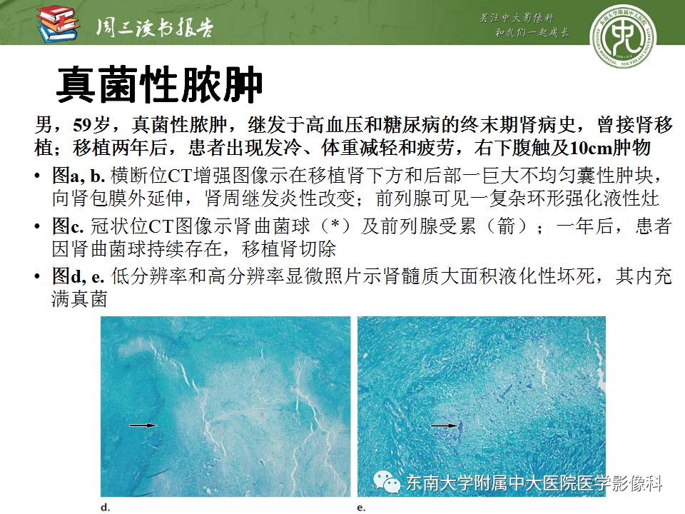 【PPT】超越前列腺腺癌：扩大前列腺病变MR鉴别诊断