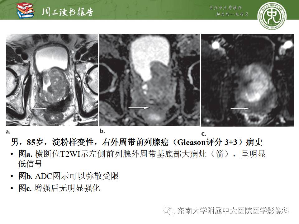 【PPT】超越前列腺腺癌：扩大前列腺病变MR鉴别诊断