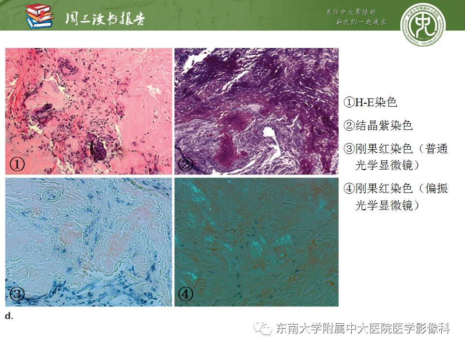 【PPT】超越前列腺腺癌：扩大前列腺病变MR鉴别诊断