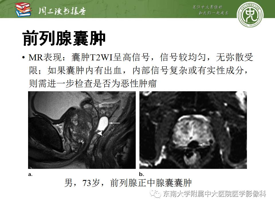 【PPT】超越前列腺腺癌：扩大前列腺病变MR鉴别诊断