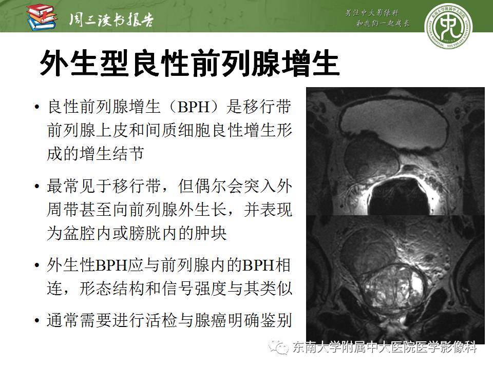 【PPT】超越前列腺腺癌：扩大前列腺病变MR鉴别诊断