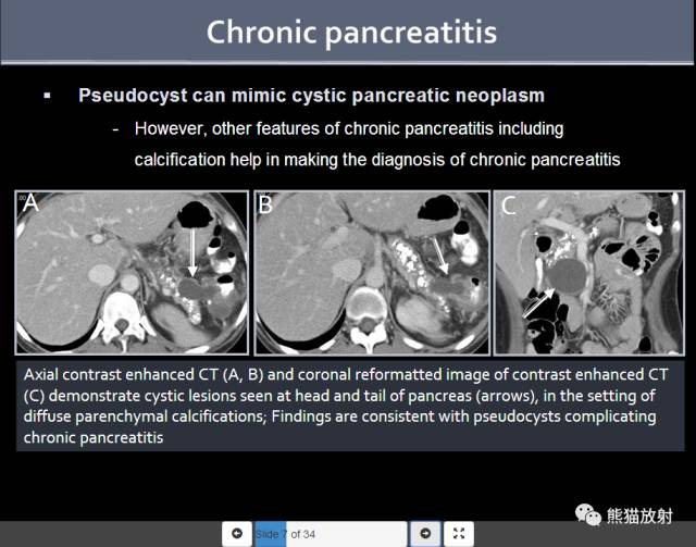 【PPT】胰腺含钙化肿物的CT诊断思路[双语]