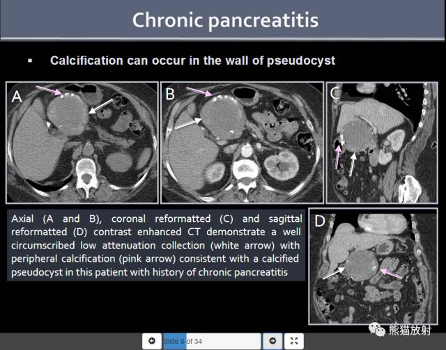 【PPT】胰腺含钙化肿物的CT诊断思路[双语]