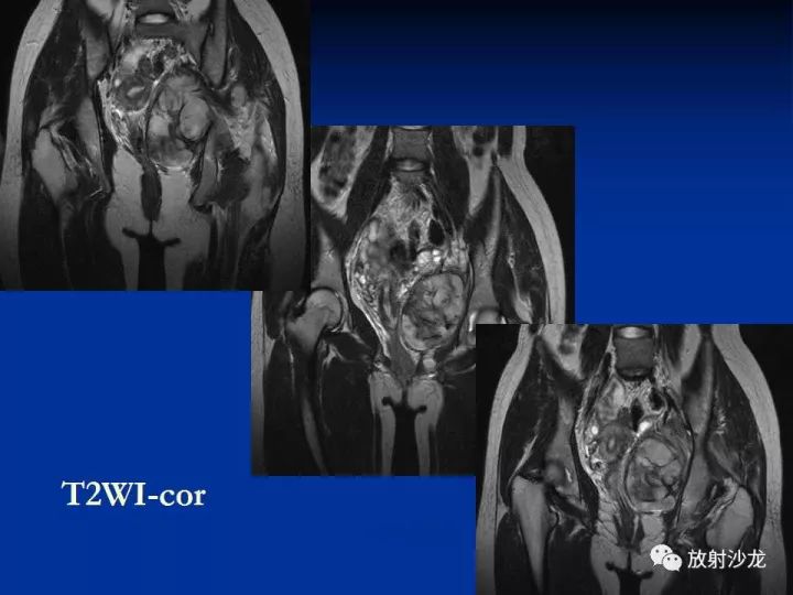 【病例】左侧坐骨大孔区纤维瘤病1例CT影像表现