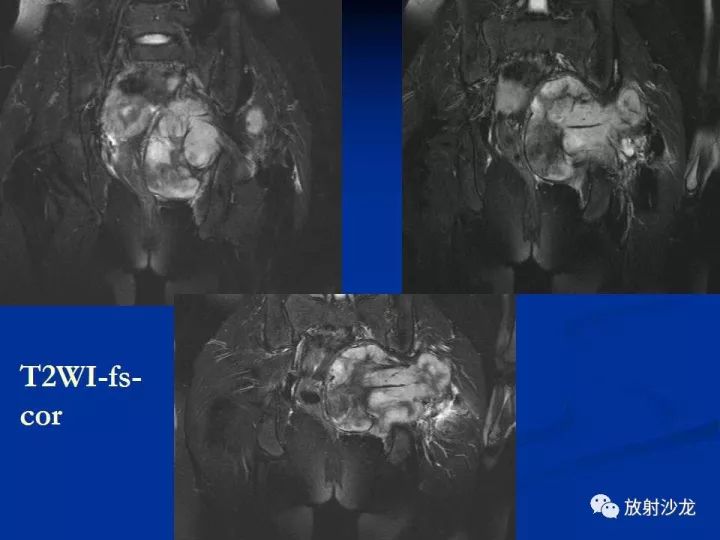 【病例】左侧坐骨大孔区纤维瘤病1例CT影像表现