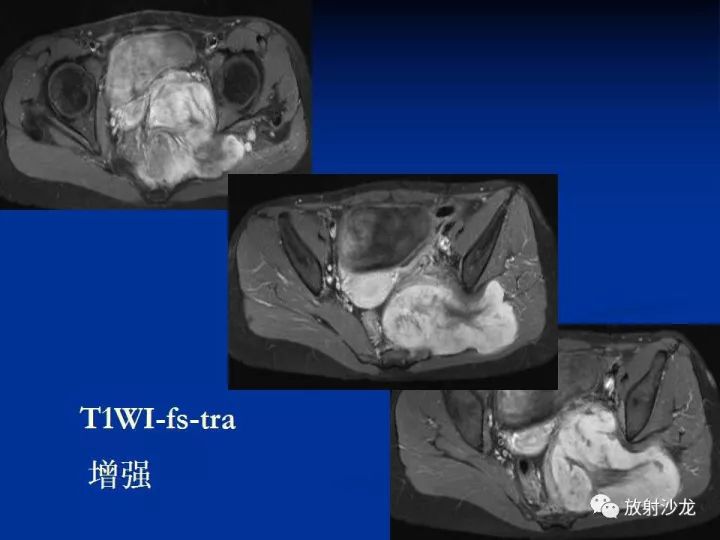 【病例】左侧坐骨大孔区纤维瘤病1例CT影像表现