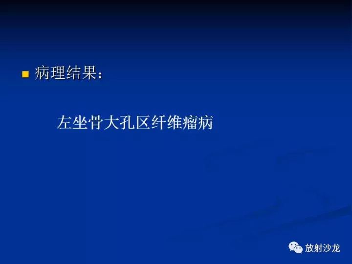 【病例】左侧坐骨大孔区纤维瘤病1例CT影像表现