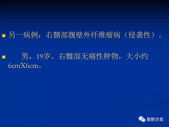 【病例】左侧坐骨大孔区纤维瘤病1例CT影像表现