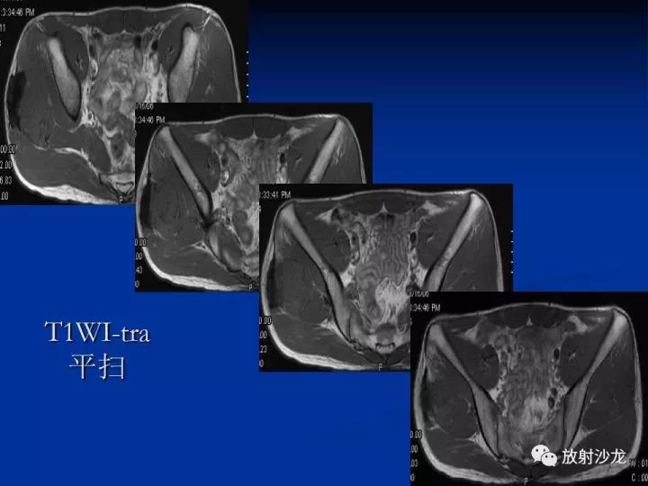 【病例】左侧坐骨大孔区纤维瘤病1例CT影像表现