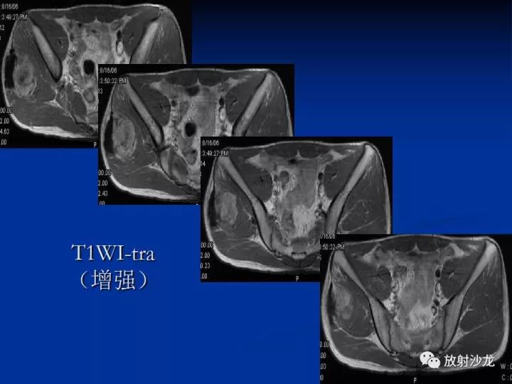 【病例】左侧坐骨大孔区纤维瘤病1例CT影像表现