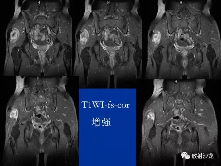 【病例】左侧坐骨大孔区纤维瘤病1例CT影像表现