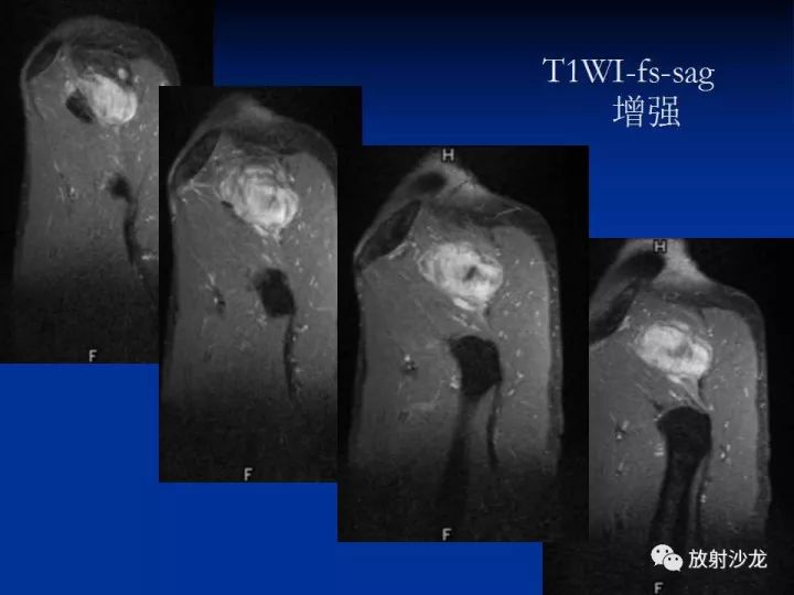 【病例】左侧坐骨大孔区纤维瘤病1例CT影像表现