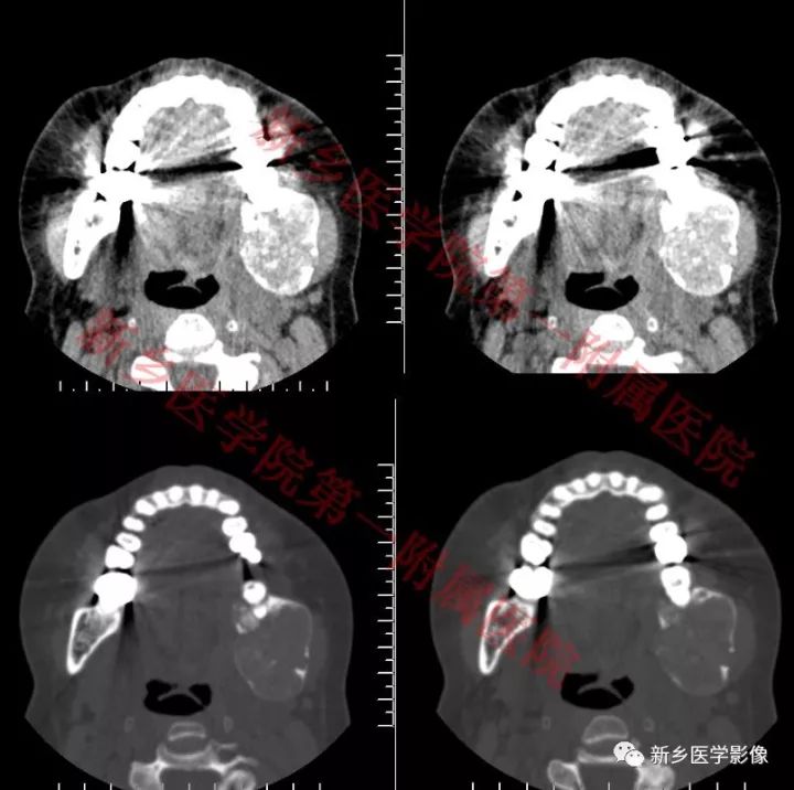 【病例】下颌骨骨化性纤维瘤1例CT影像表现