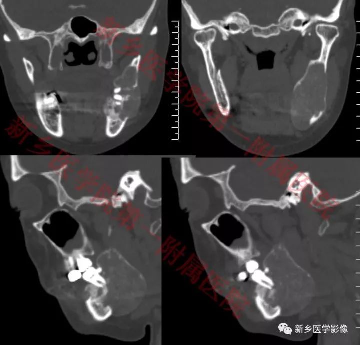 【病例】下颌骨骨化性纤维瘤1例CT影像表现 【病例】下颌骨骨化性纤维瘤1例CT影像表现